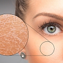 Skin disease treatment