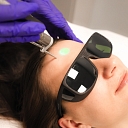 Laser hair removal procedure