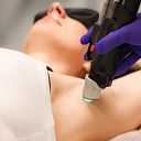 Лазерная эпиляция в Риге