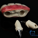 Combined prosthesis of PEEK material and zirconium