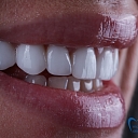Veneers for smile enhancement