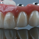 Zirconia bridge on implants