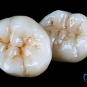 Pressed ceramic and composite onlays