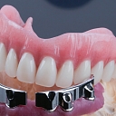 Combined plastic and metal prostheses