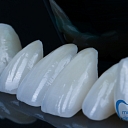 Veneers or porcelain plates