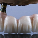 Crowns of different materials on implants