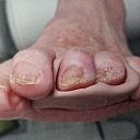 Production of individual orthosis