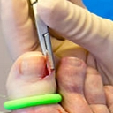 ingrown nail care