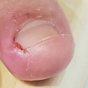 ingrown nail care