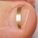 Ingrown nail correction