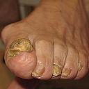 treatment of injured or damaged nails