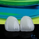 Pressed ceramic crowns