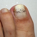 ingrown nail correction