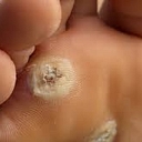 Wart or corn treatment