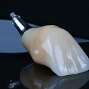 Crowns of different materials on implants