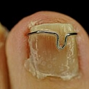 ingrown nail correction