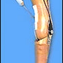 Prosthesis
