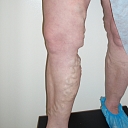 Vein center clinic in Aluksne, Limbaži, Madona