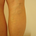 Vein Center Clinic in Riga, Cesis, Valmiera