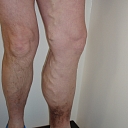 Vein treatment operations in Aluksne, Limbaži, Madona