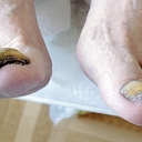 Заболевания ногтей на ногах
