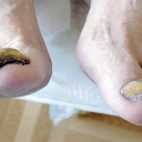 Toenail diseases