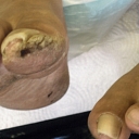 Treatment of mycosis