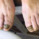 Treatment of ingrown nails