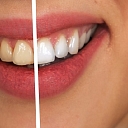 Teeth whitening