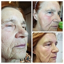 meso procedure for face