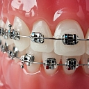 Braces