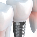 dental implantation
