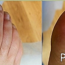 Damaged nail restoration