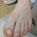 Ingrown nails