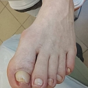 Ingrown nails