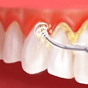 Plaque and tartar removal