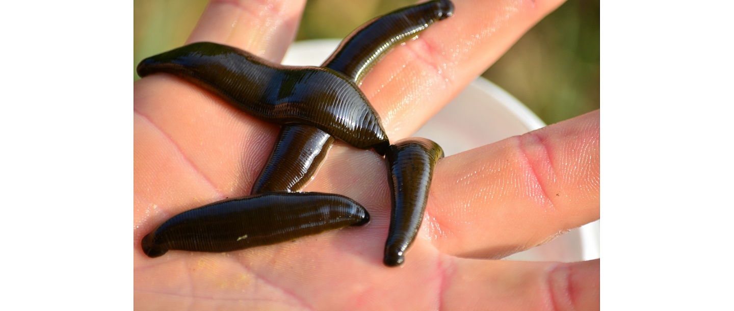 leech therapy