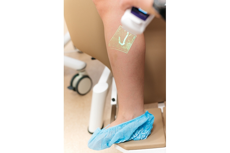 Vein problems