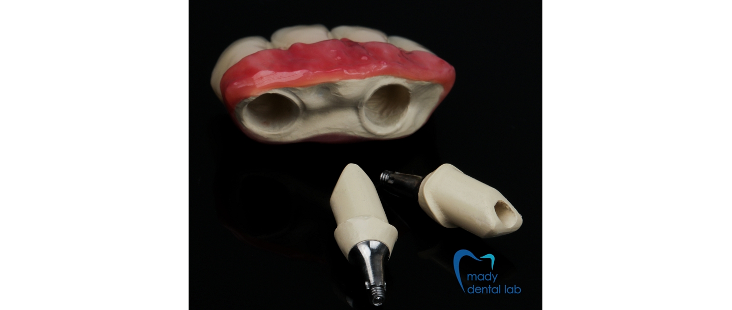 Combined prosthesis of PEEK material and zirconium