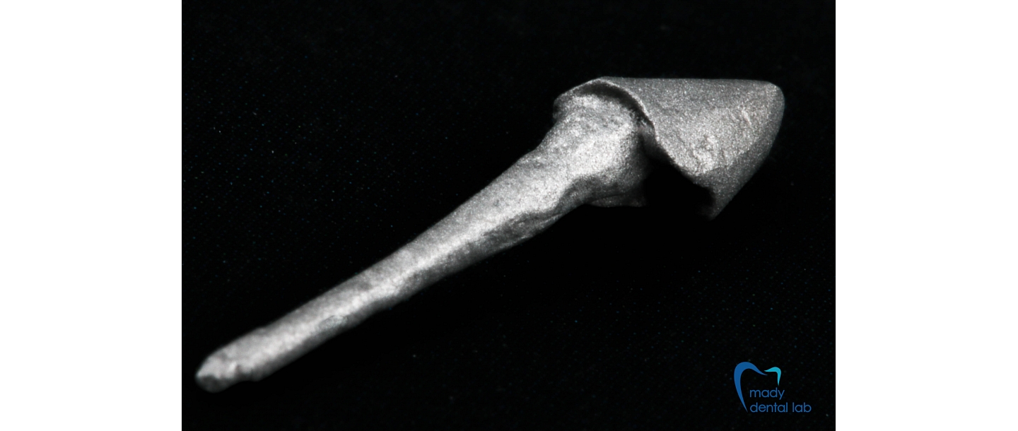 Metal and zirconium inlays