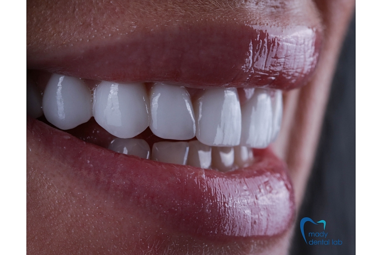 Veneers for smile enhancement