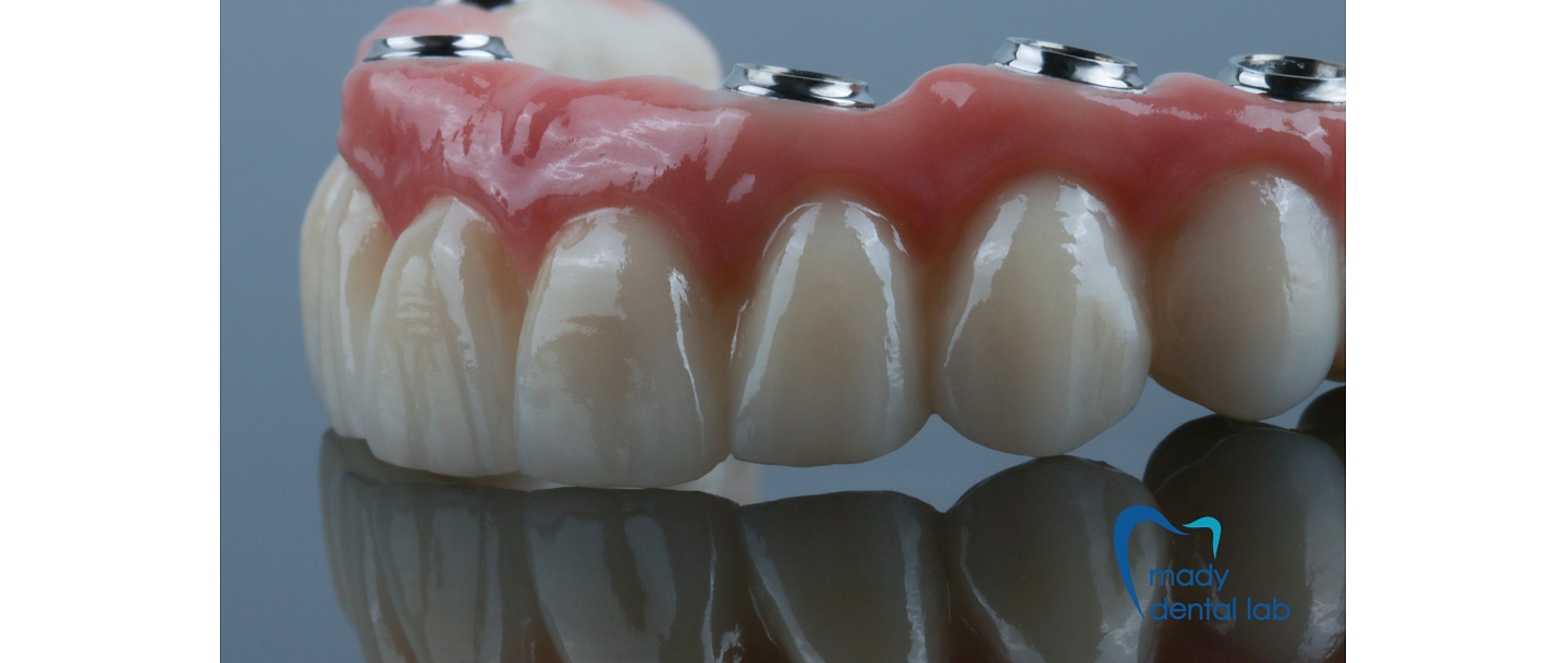 Zirconia bridge on implants
