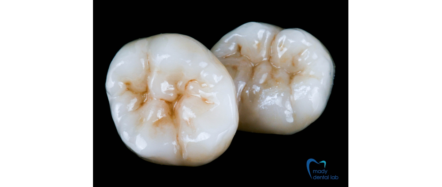 Pressed ceramic and composite onlays