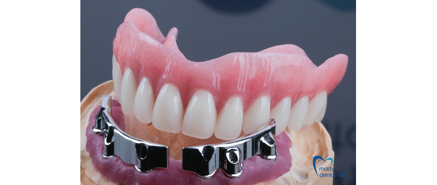 Combined plastic and metal prostheses