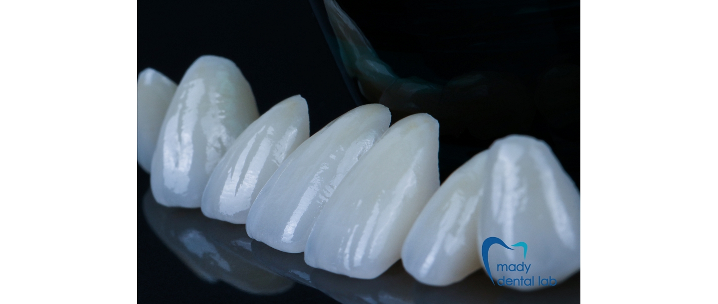 Veneers or porcelain plates