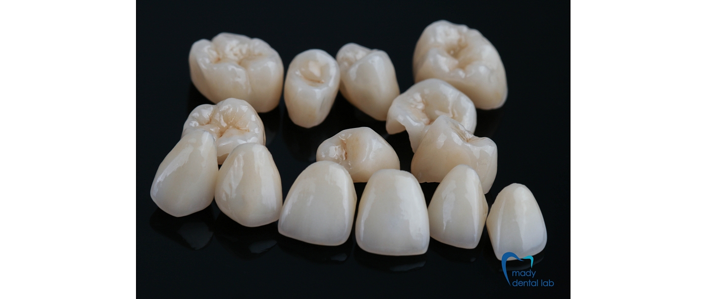 Pressed ceramic crowns