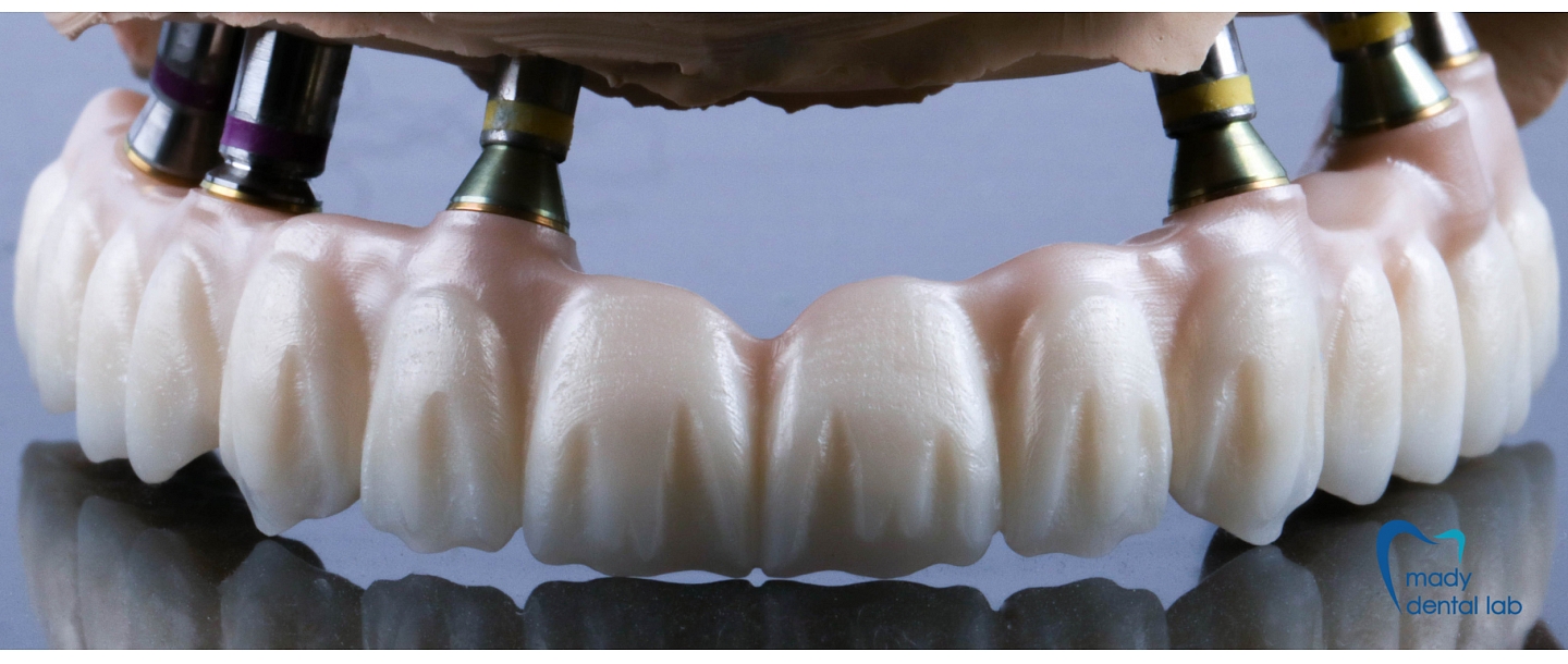 Crowns of different materials on implants