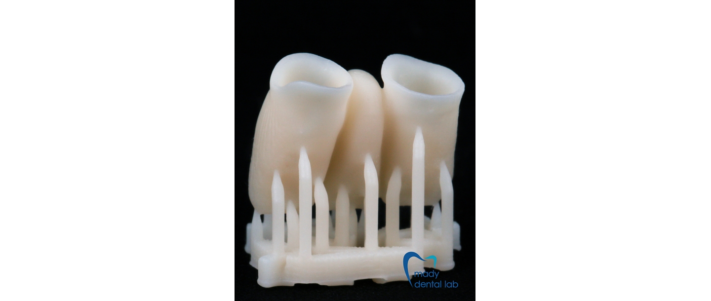 3D принтированные временные короны