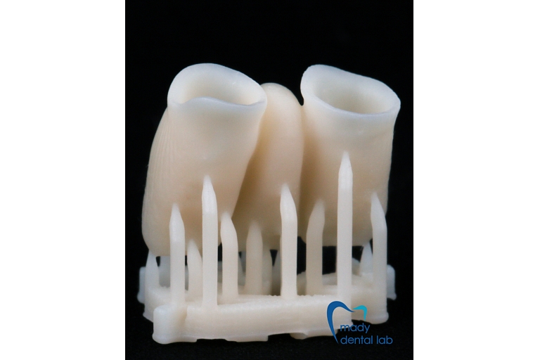 3D printed temporary crowns