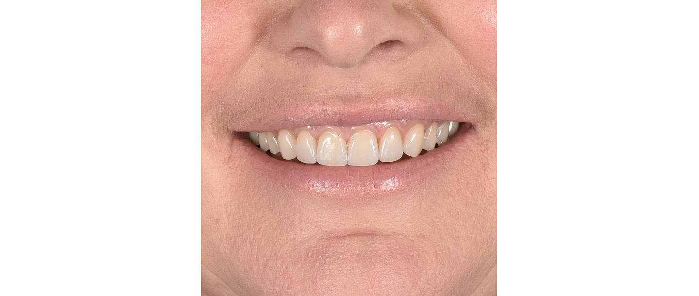 Dental prosthetics in Rezekne
